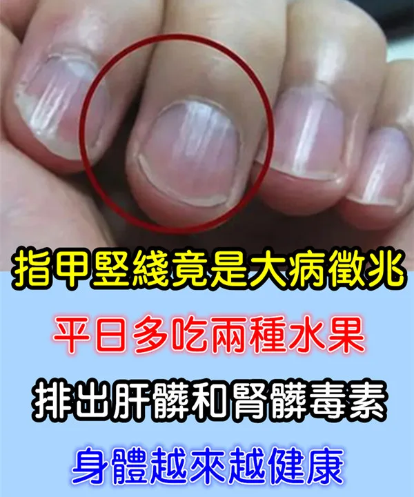 指甲豎線是大病徵兆？多吃蔓越莓、西瓜助排肝腎毒素 第 1 張